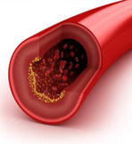 High Cholesterol